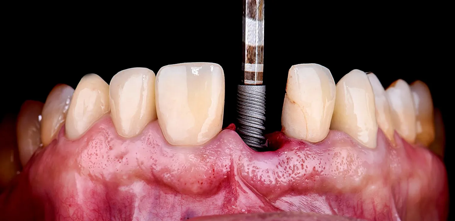 Implanty dentystyczne w Szczecinie