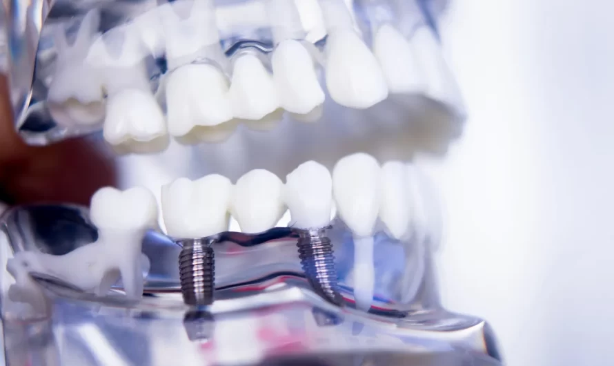 Implanty stomatologiczne – kto wymyślił?