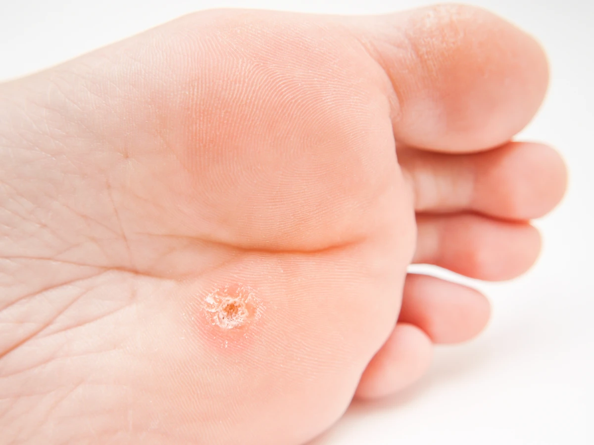 Pedicure leczniczy - czym jest, jak wygląda, kiedy warto go wybrać?