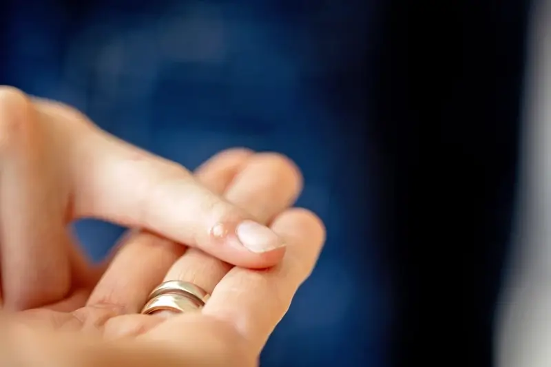 Jak wygląda rdzeń kurzajki?